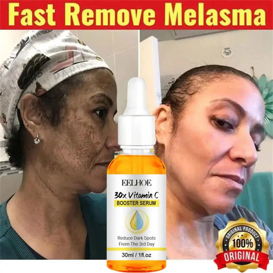 VC Whitening Freckles Face Serum for removing melasma and dark spots with Vitamin C.