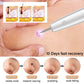 Laser Plasma Pen Mole Wart Remover Black Dots Freckle Dark Spot Remover Plasma Pen Wart Eliminator Papilloma Skin Tag Removal