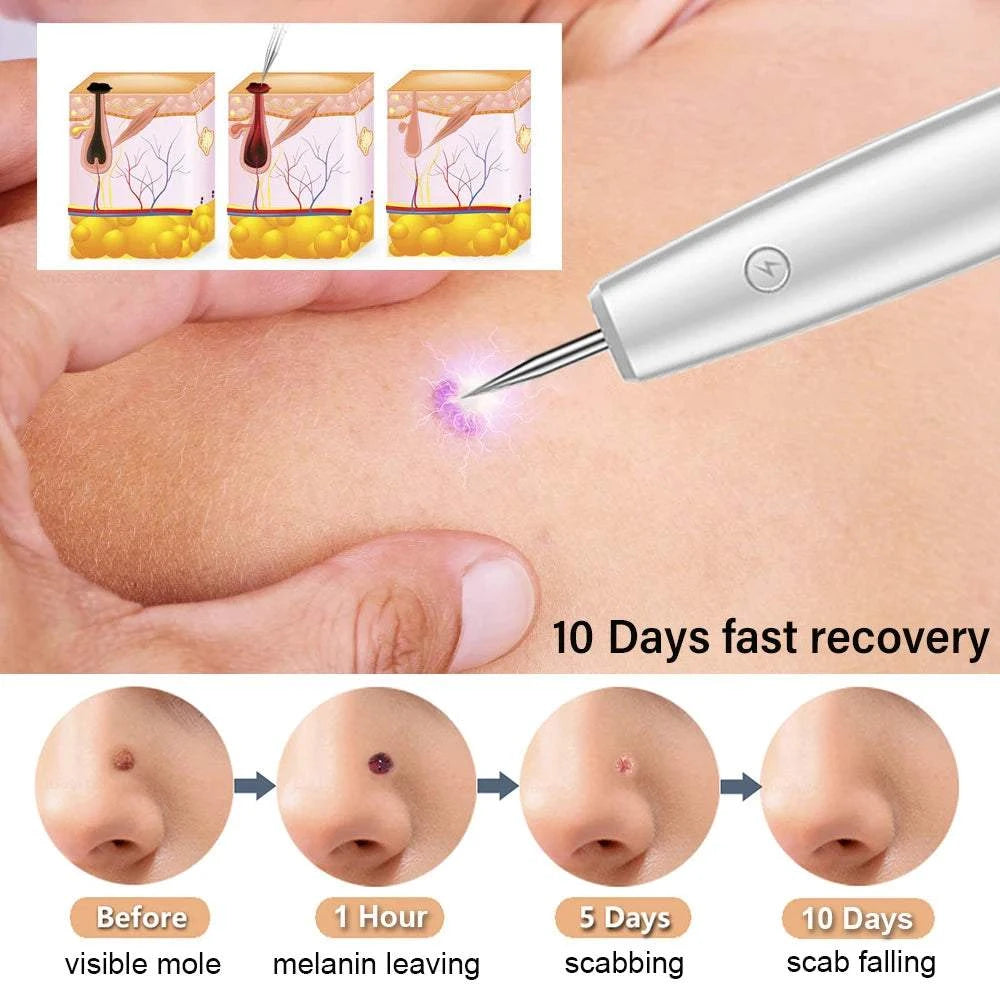 Laser Plasma Pen Mole Wart Remover Black Dots Freckle Dark Spot Remover Plasma Pen Wart Eliminator Papilloma Skin Tag Removal