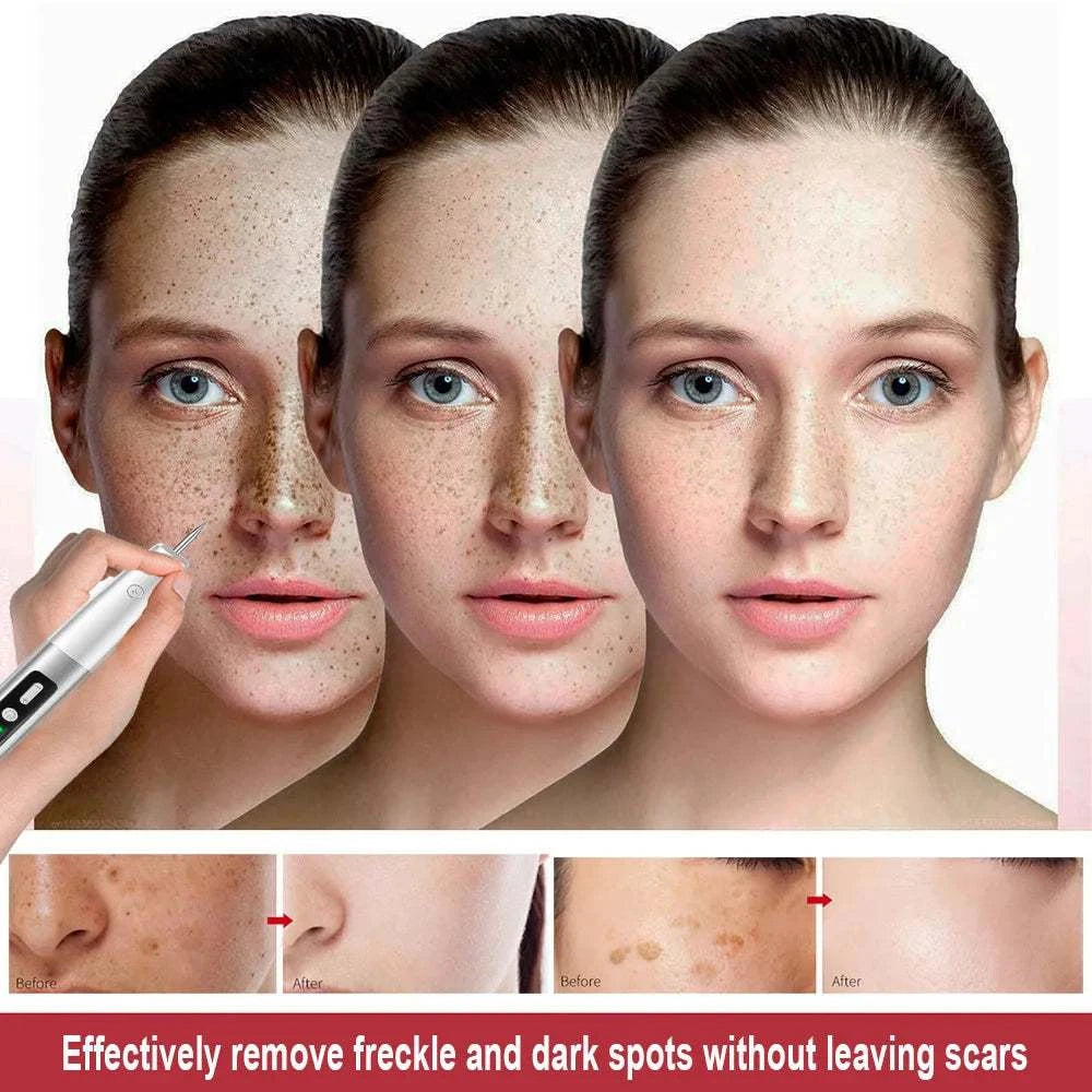 Laser Plasma Pen Mole Wart Remover Black Dots Freckle Dark Spot Remover Plasma Pen Wart Eliminator Papilloma Skin Tag Removal